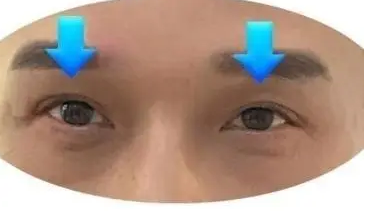 双眼皮