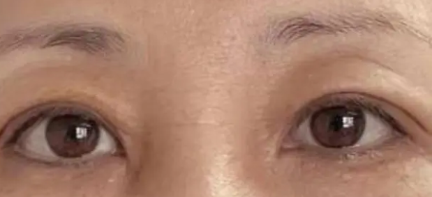 双眼皮手术