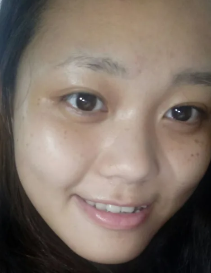 双眼皮手术