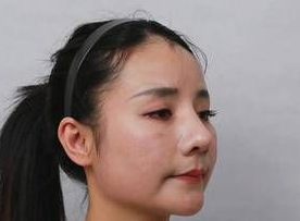 双眼皮手术