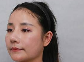 双眼皮手术