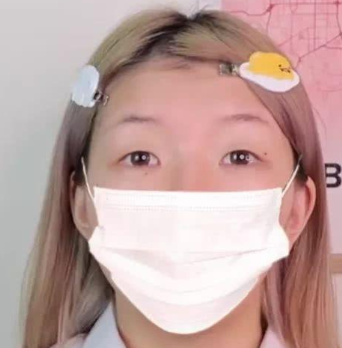 双眼皮手术