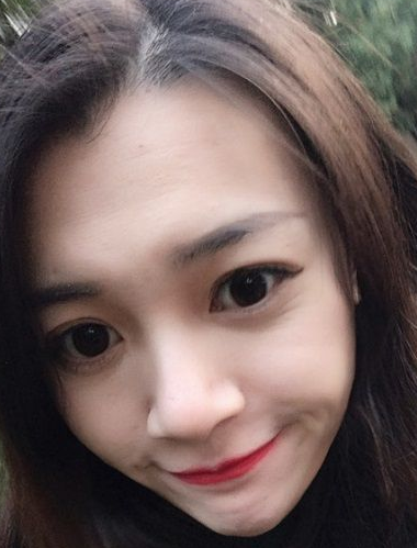 双眼皮手术