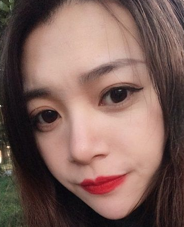 双眼皮手术
