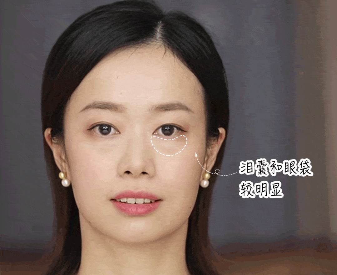 去眼袋手术