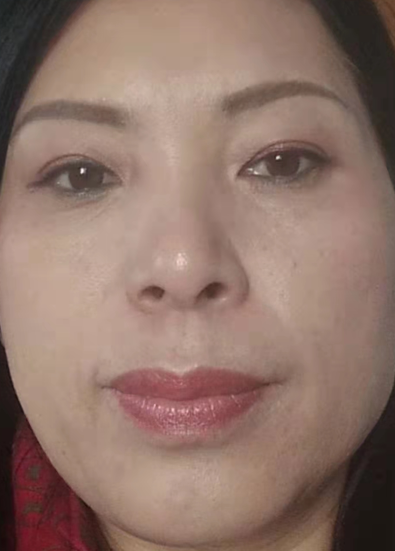 去眼袋手术