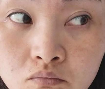 去眼袋手术