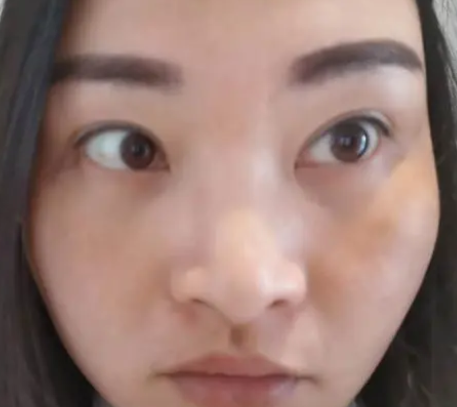 去眼袋手术