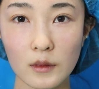 眼袋