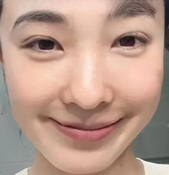 眼袋