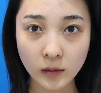 眼袋