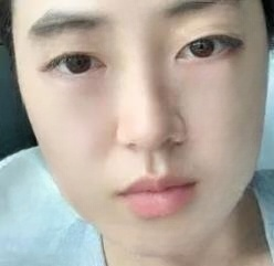 眼袋