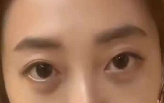 眼袋