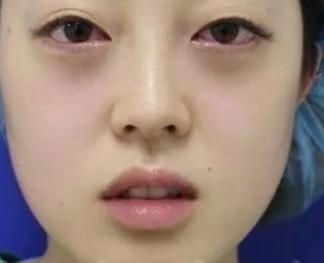 眼袋