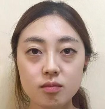 眼袋