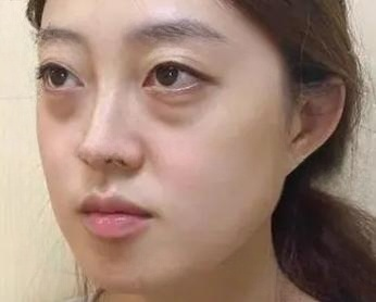 眼袋