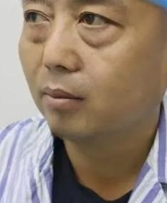 去眼袋手术