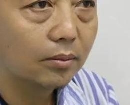 去眼袋手术