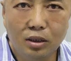 去眼袋手术