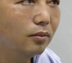 去眼袋手术