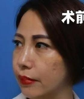 去眼袋手术