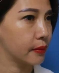 去眼袋手术