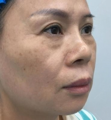 去眼袋手术