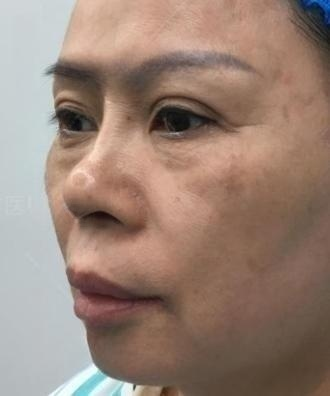 去眼袋手术