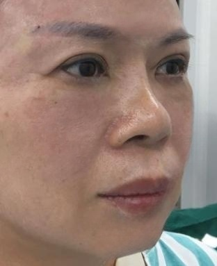 去眼袋手术