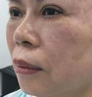 去眼袋手术
