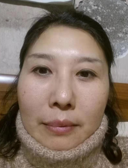 去眼袋手术