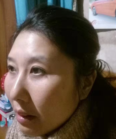 去眼袋手术