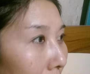 去眼袋手术