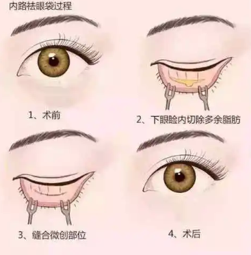 去眼袋手术