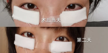 去眼袋手术