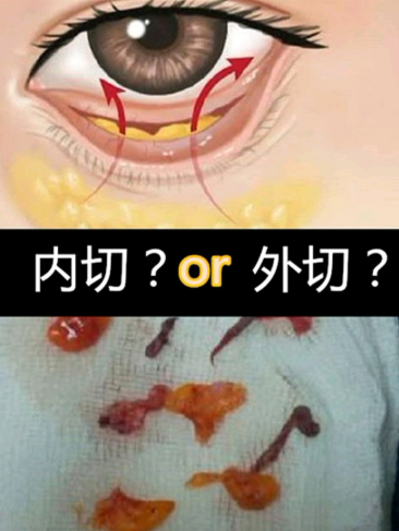 去眼袋手术