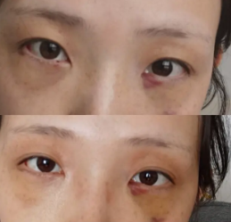去眼袋手术
