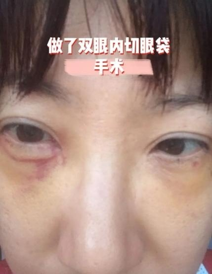 去眼袋手术