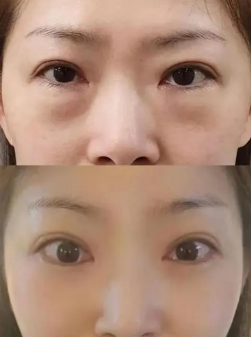 去眼袋手术