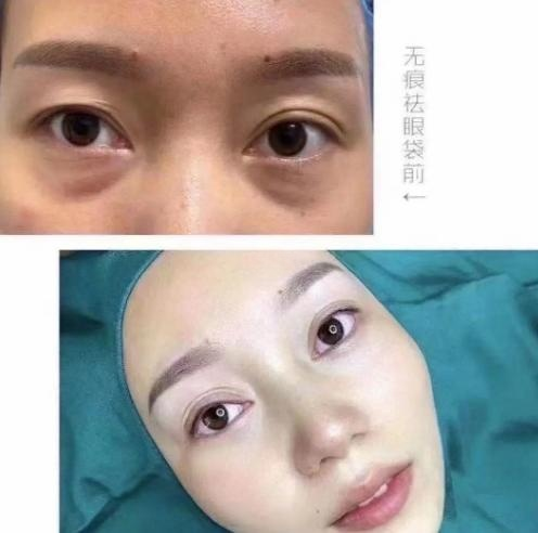 去眼袋手术