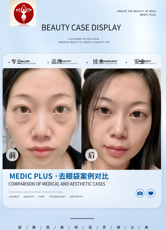 去眼袋手术