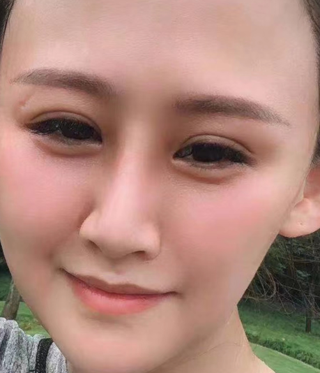 去眼袋手术