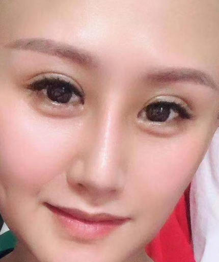 去眼袋手术