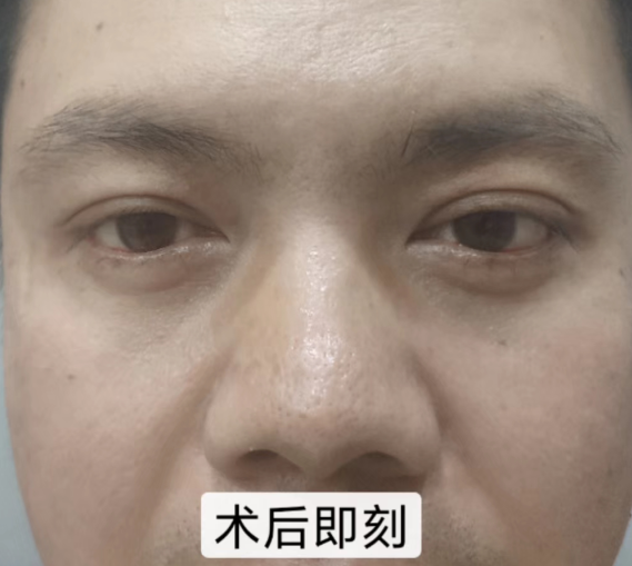 去眼袋手术