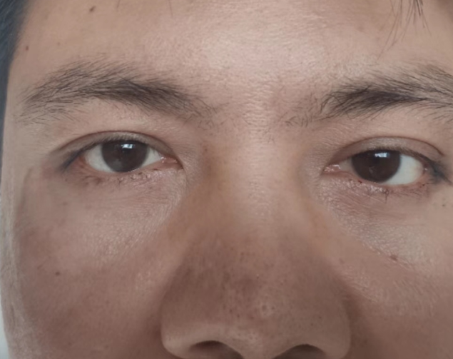 去眼袋手术
