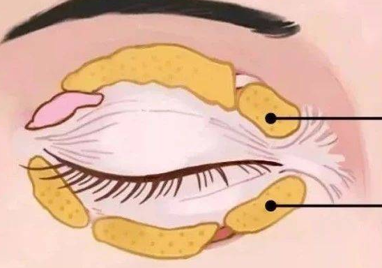 去眼袋手术
