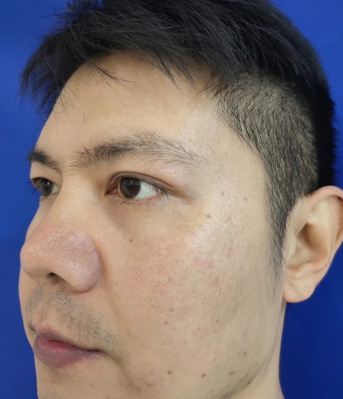 去眼袋手术