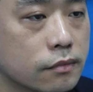 去眼袋手术