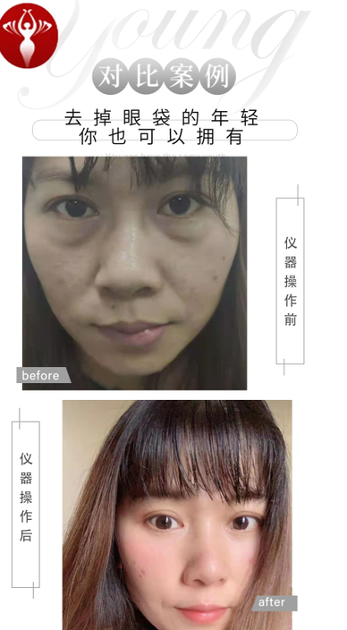 去眼袋手术