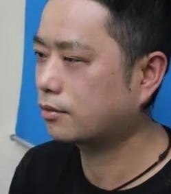 去眼袋手术